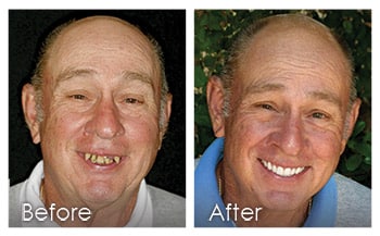 The Denture Fountain of Youth