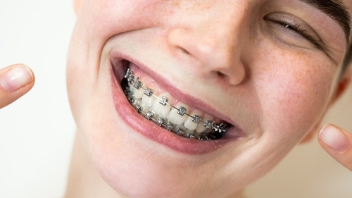 Braces in Cleveland, TN Center for Cosmetic Dentistry
