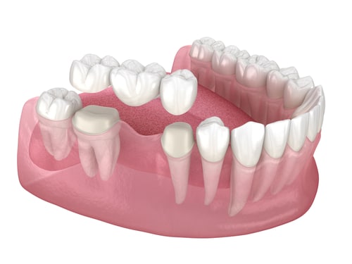 Dental Bridges in Cleveland, TN Center for Cosmetic Dentistry