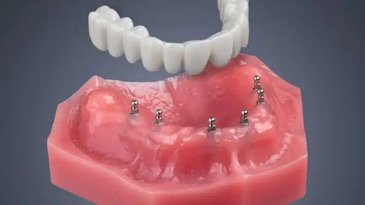 Mini Dental Implants in Cleveland, TN - Center for Cosmetic Dentistry - Dr. Kenneth Beard