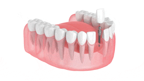Mini Dental Implants in Cleveland, TN