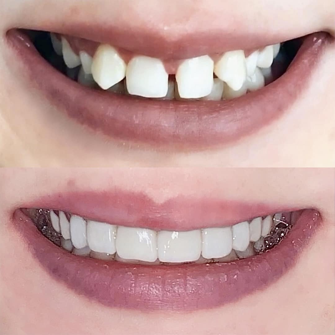 Smile Makeover in Cleveland, TN - Center for Cosmetic Dentistry - Dr. Kenneth Beard