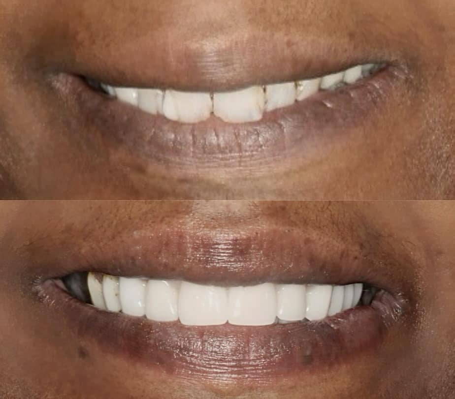 Smile Makeover in Cleveland, TN - Center for Cosmetic Dentistry - Dr. Kenneth Beard