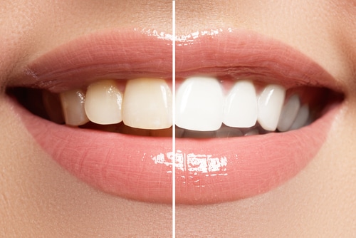 Teeth Whitening in Cleveland, TN Center For Cosmetic Dentistry