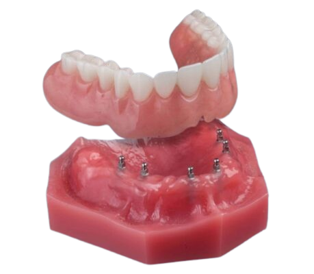 Snap-On Dentures in Cleveland, TN | Mini Implants | Dr. Beard