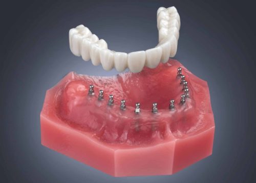 Implant-Supported Dentures in Cleveland, TN | Mini Implants