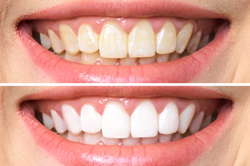 Cleveland Teeth Whitening | Cosmetic Dentist in TN | Dr. Beard