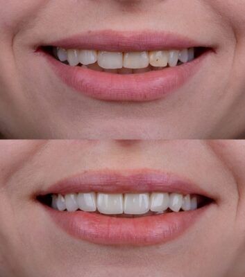Veneers in Cleveland, TN | Schedule a Free Consultation Today