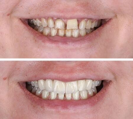 Cosmetic Dentistry in Cleveland, TN | Book a Free Consultation