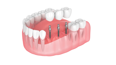 Dental Implants in Tennessee | Mini Implants Secure Your Smile