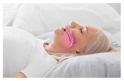 Sleep Apnea Treatment in Cleveland, TN | Free Consultations