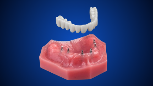 Roundhouse Bridge Denture Solutions in Cleveland, TN