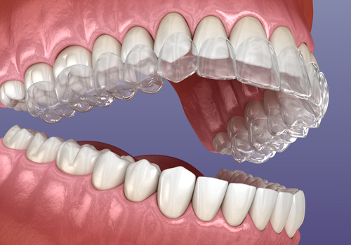 Invisalign Aligners in Cleveland, TN | Book a Free Consultation