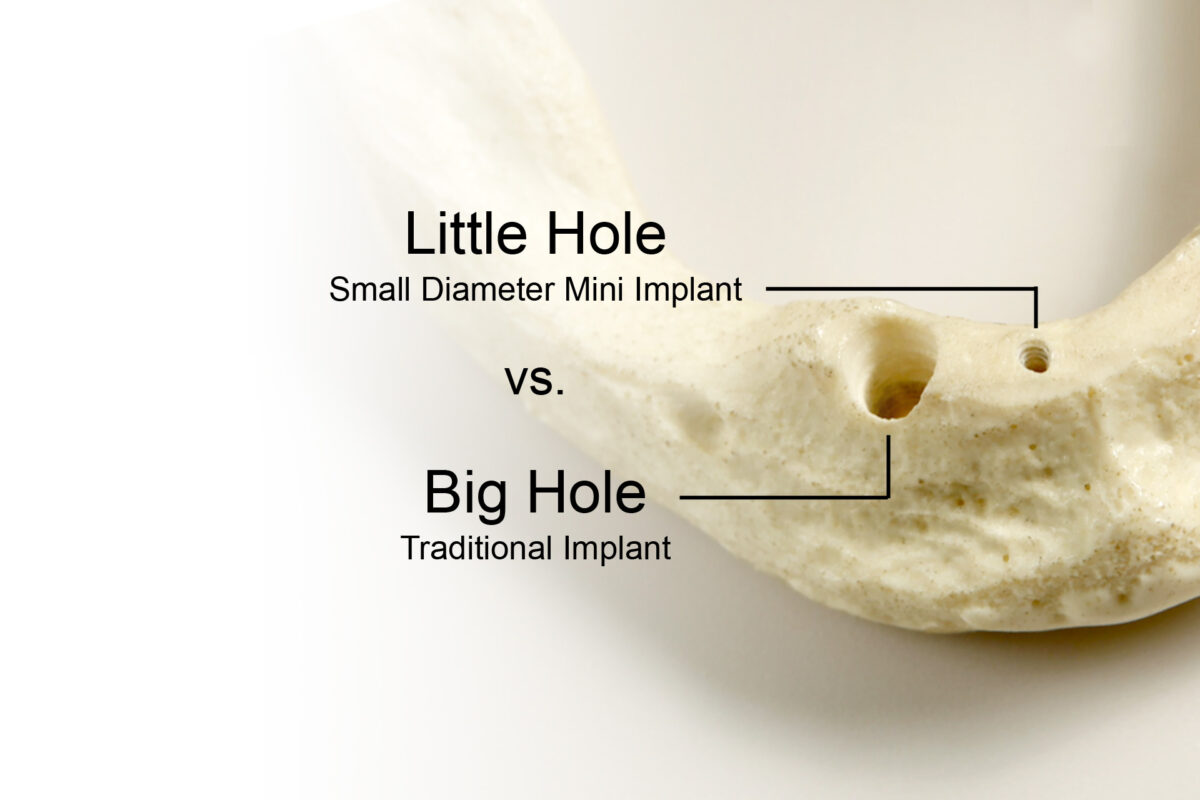 Dental Implants in Cleveland, TN | Book a Free Consultation