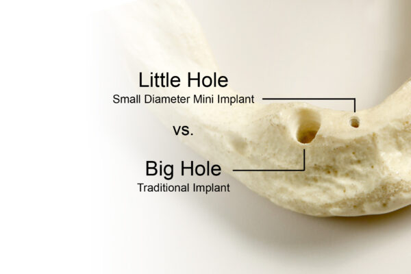 Dental Implants in Cleveland, TN | Book a Free Consultation