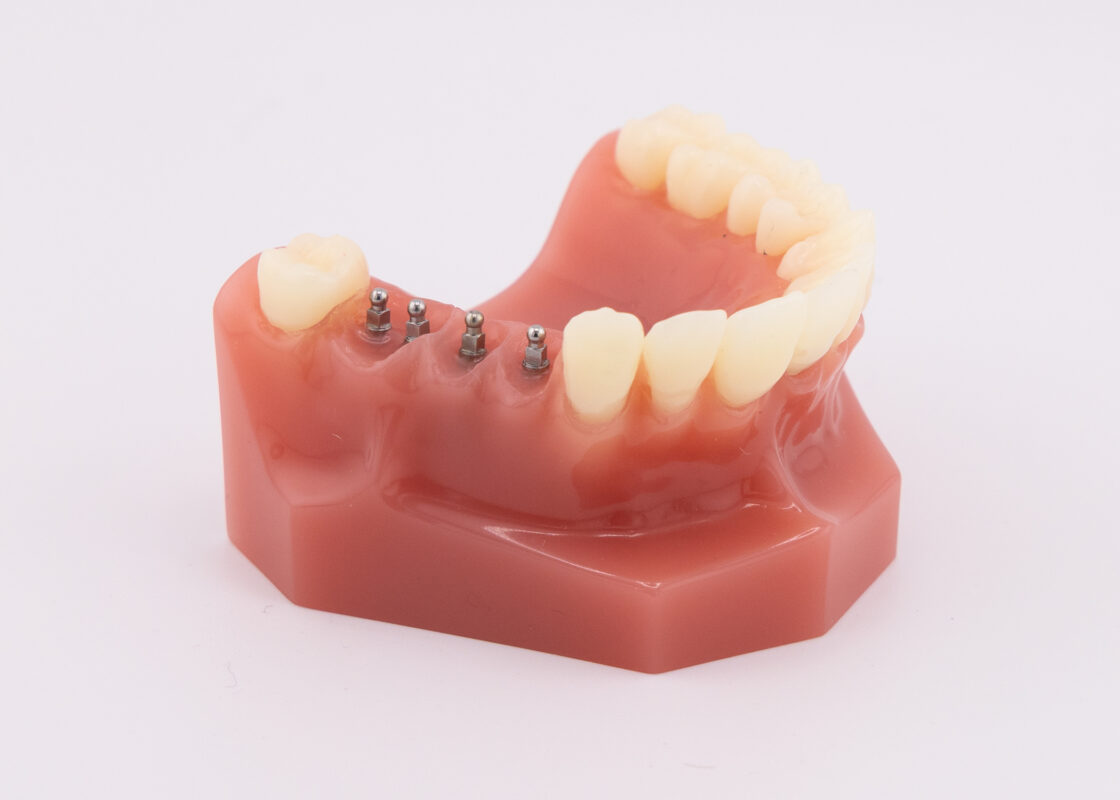 Dental Implants in Cleveland, TN | Free Mini Implant Consultations!