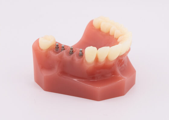 Dental Implants in Cleveland, TN | Free Mini Implant Consultations!