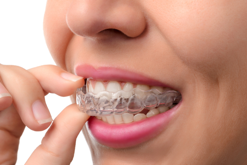 Alternatives to Braces in Cleveland, TN | Book a Free Consultation