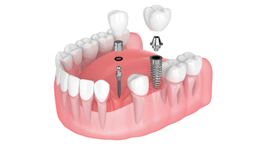 Mini Implants Cost in Cleveland, TN | Mini Implants vs. Conventional Implants