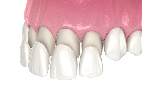 Porcelain Veneers Cost in Cleveland, TN | The Veneers Process