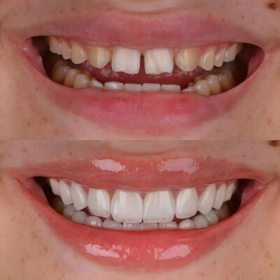 Porcelain Veneers Cost in Cleveland, TN | Get Your Dream Smile