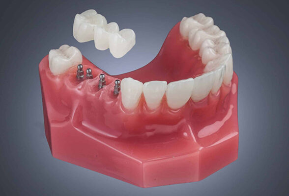 Mini Implants for Teeth in Cleveland, TN | Free Consultation
