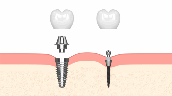 Traditional vs. Mini Dental Implant Costs in Cleveland, TN