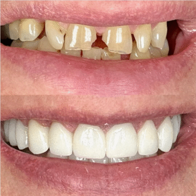 Crowns vs. Veneers in Cleveland, TN | Free Dental Implant Consult