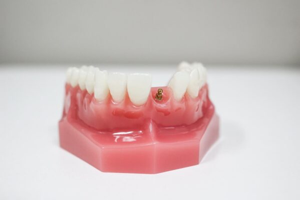 Mini Dental Implant in Cleveland, TN | Free Implant Consults