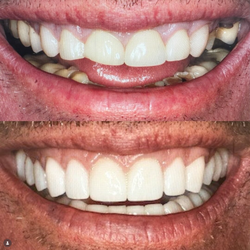 Crowns vs. Veneers in Cleveland, TN | Free Smile Consultation