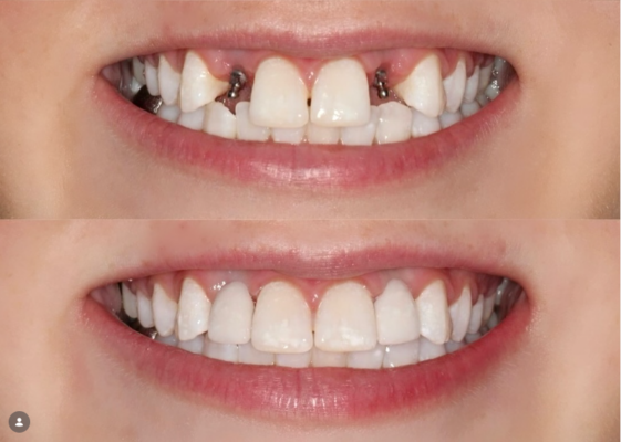 Dental Crown in Cleveland, TN | Free Dental Implant Consult