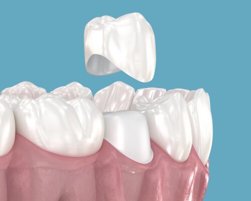 Dental Crowns in Cleveland, TN | Free Consultations