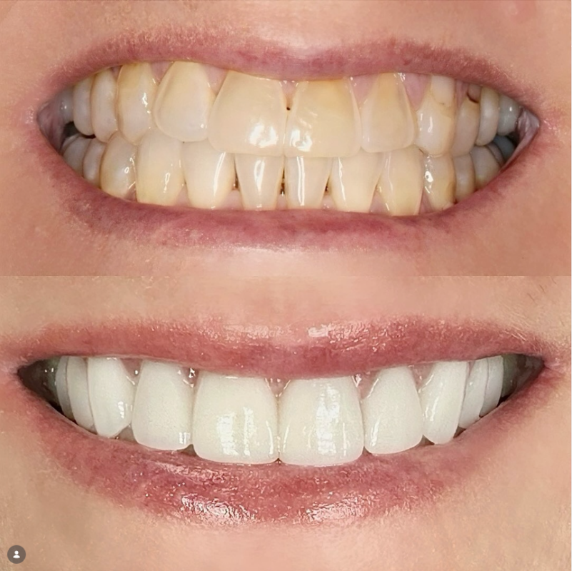 Veneer vs. Crown in Cleveland, TN [Before and After]