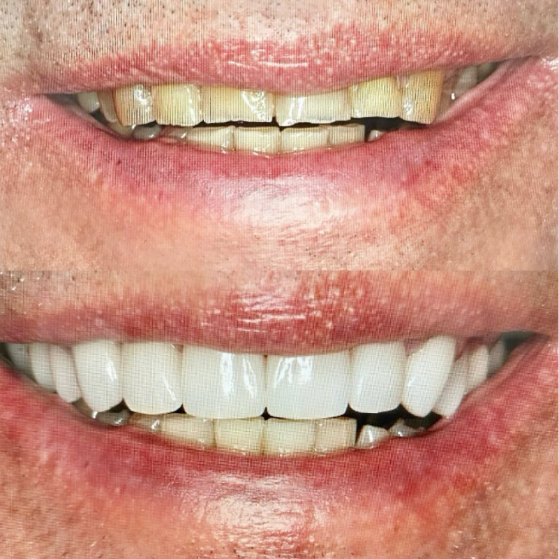 Dental Makeover in Cleveland, TN [Real Patient Example Inside]
