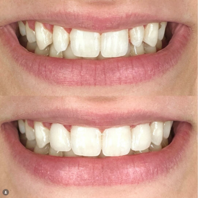 Front Teeth Veneers in Cleveland, TN [Before and After] ✨🦷
