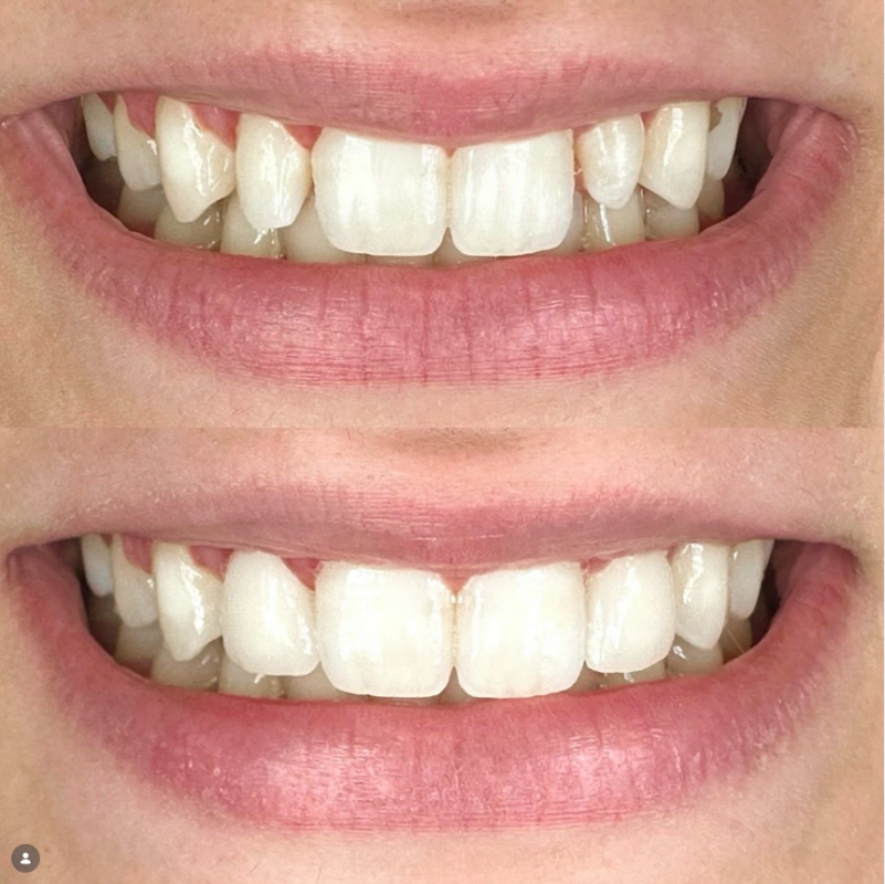 Front Teeth Veneers in Cleveland, TN [Before and After] ✨🦷