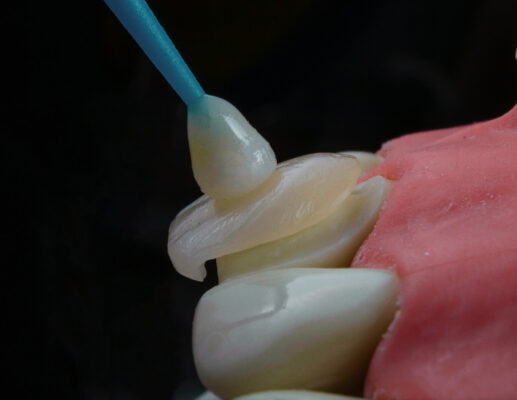 Veneers Process in Cleveland, TN | Free Lumineers® Consultation